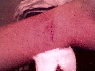 Stitches